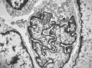 F, 57y. | mycosis fungoides … cerebriform nucleus of Sézary cell F, 57y. | mycosis fungoides … cerebriform nucleus of Sézary cell